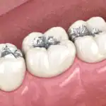 3D illustration of multiple teeth with silver fillings