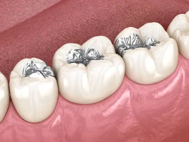 3D illustration of multiple teeth with silver fillings