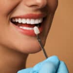 How long do veneers last Woodinville